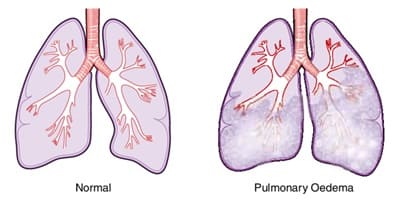 Immersion Pulmonary Edema Symptoms and Treatment (IPE)